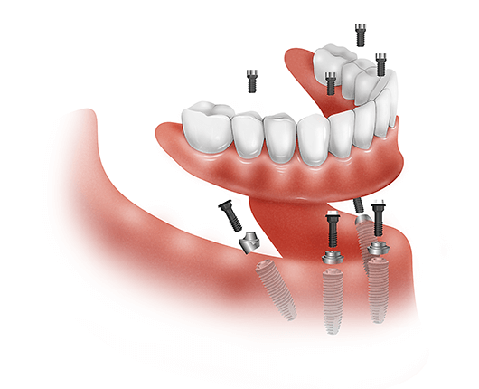 Are dental implants all one piece