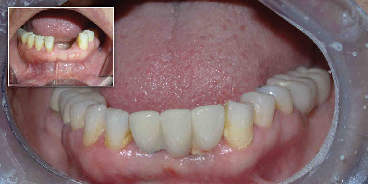 Are dental implants all the same?