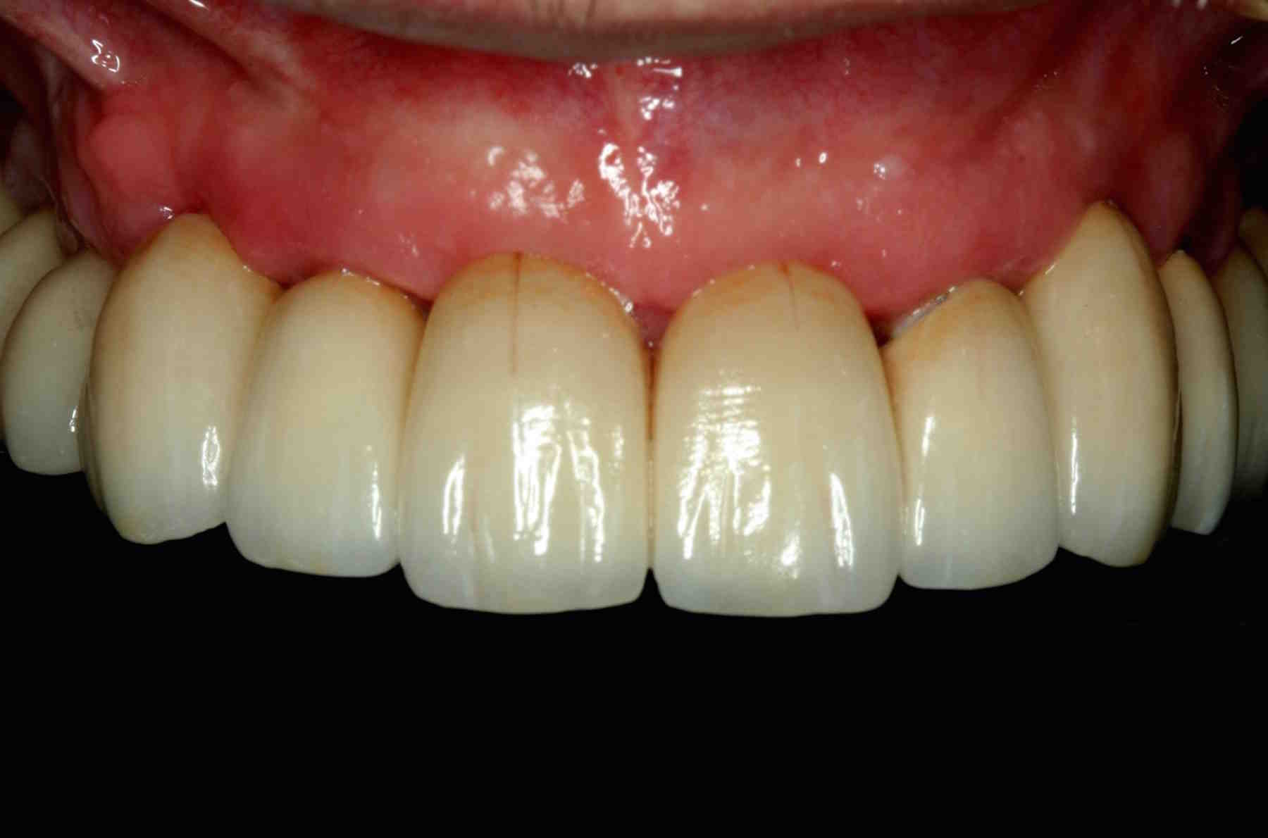 Are dental implants done individually?