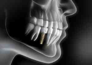 Are dental implants pure titanium?