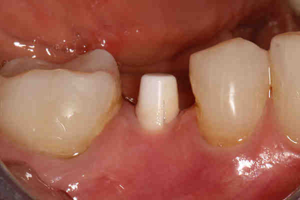 Are dental implants toxic?