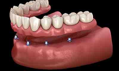 Are hybrid dentures covered by insurance?