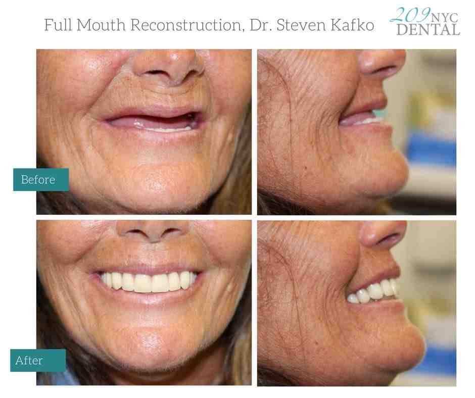 Are implants better than dentures?