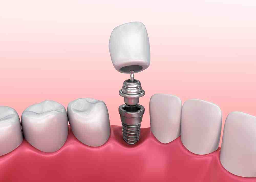 Are implants restorative dentistry?