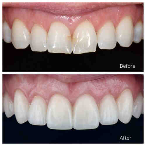 Cosmetic dentistry same day veneer Dental News Network