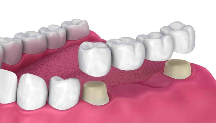 Are there any dangets from mini dental implants