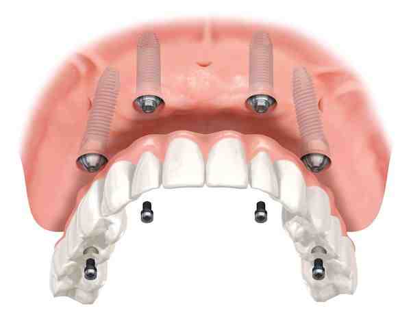 will-va-pay-for-dental-implants-dental-news-network