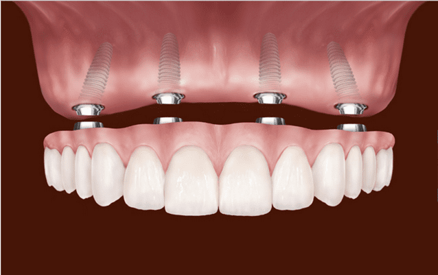 Can I see my dental implant?