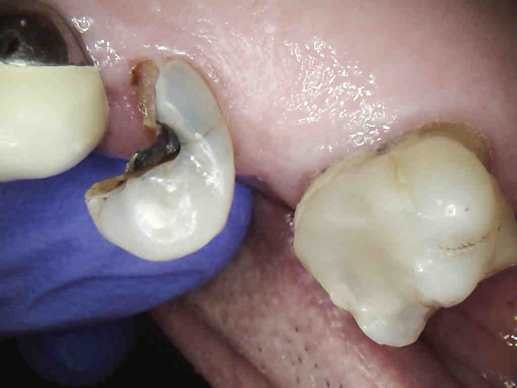 what-age-can-you-get-a-dental-implant-dental-news-network