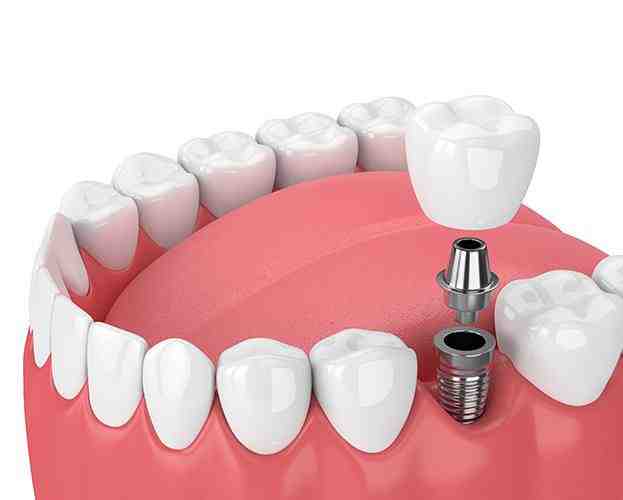 Can a dental implant be reinserted?