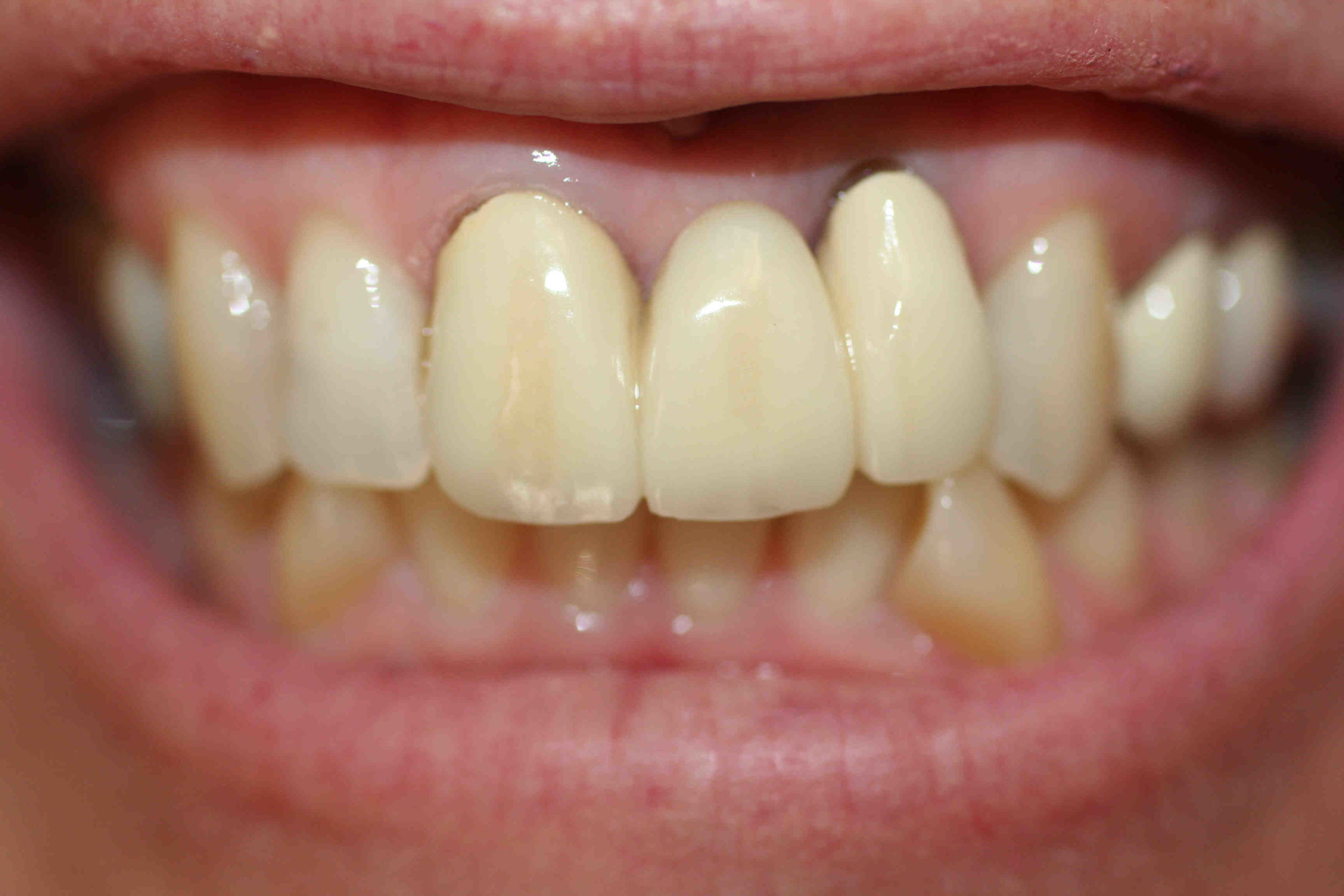 Can a dental implant be whitened?