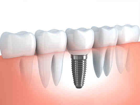 Can a general dentist perform dental implants?