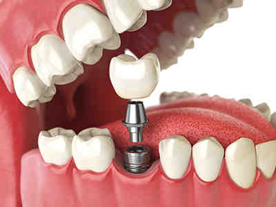 Can dental implants be done in 1 day?