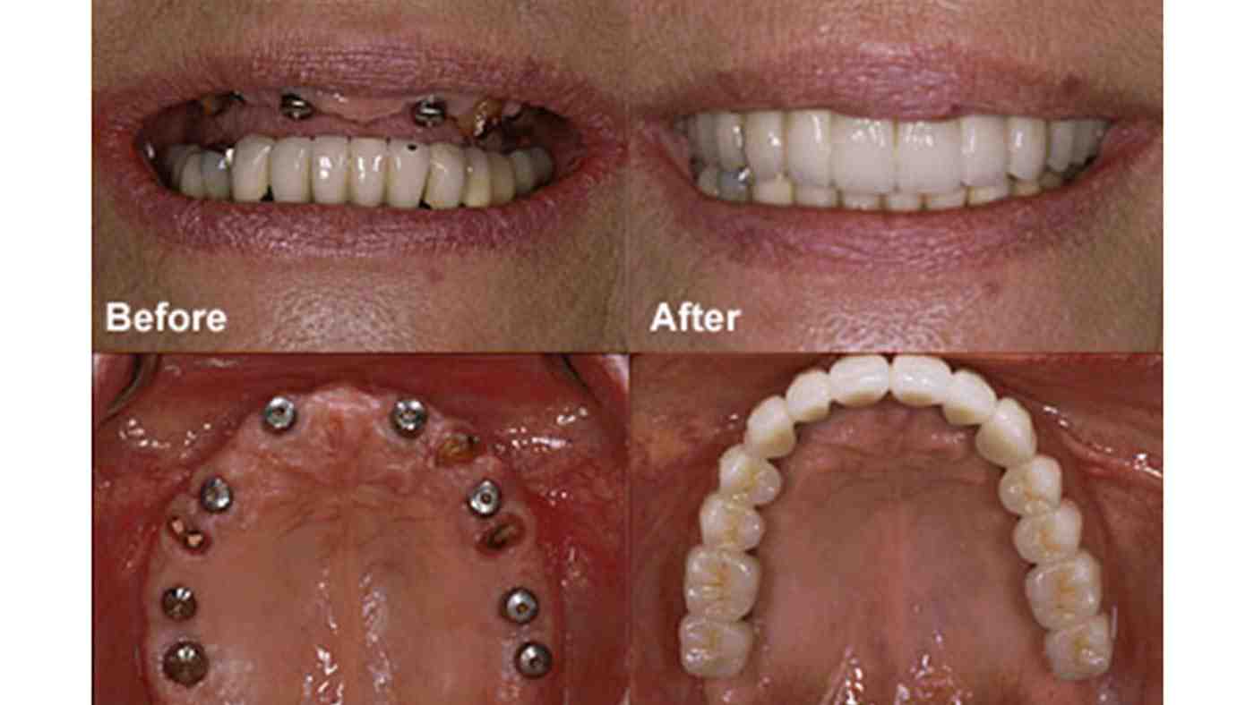 Can dental implants be fitted in one day?