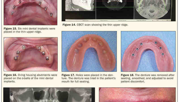 Can mini dental implants be used for upper dentures?