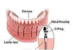 Can mini implants be used for front teeth?