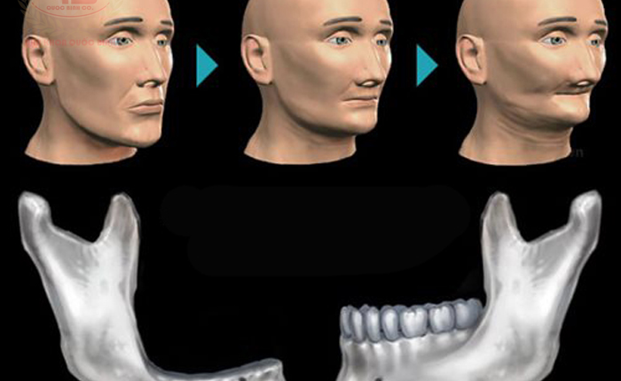 Can you do dental implants if most of the bone is lost in upper jaw