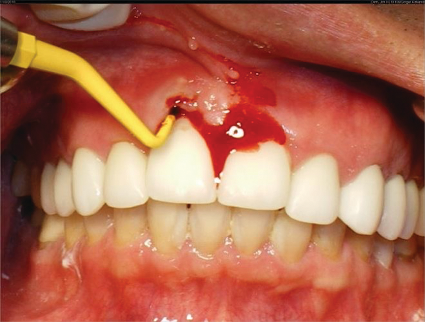 Should there be a clot over the dental implant Dental News Network