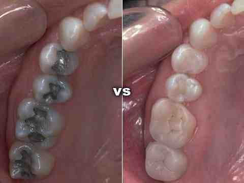 Can you get dental implants If you have very little bone?