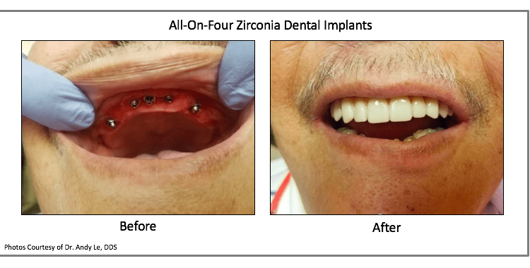 Can you get dental implants if you smoke