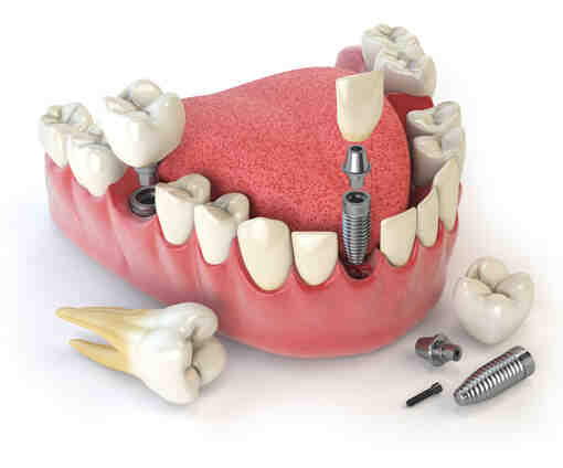 Can you get full dental implants in one day?