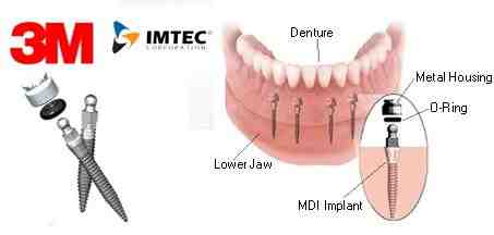 Can you get mini implants for upper dentures?