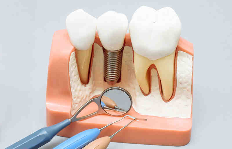 Can You Get Multiple Dental Implants At Once