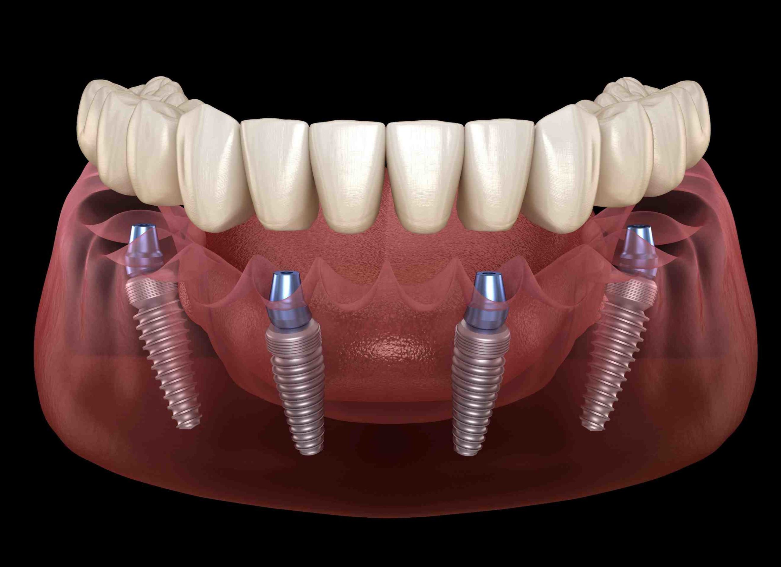 Can you have dental implants If you have dentures?