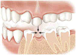 Can you use adhesive with implants?
