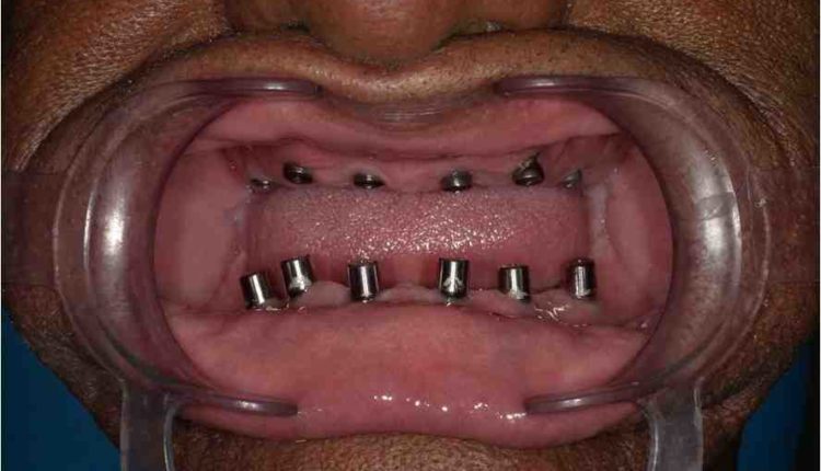 Cosmetic dentistry punta cana