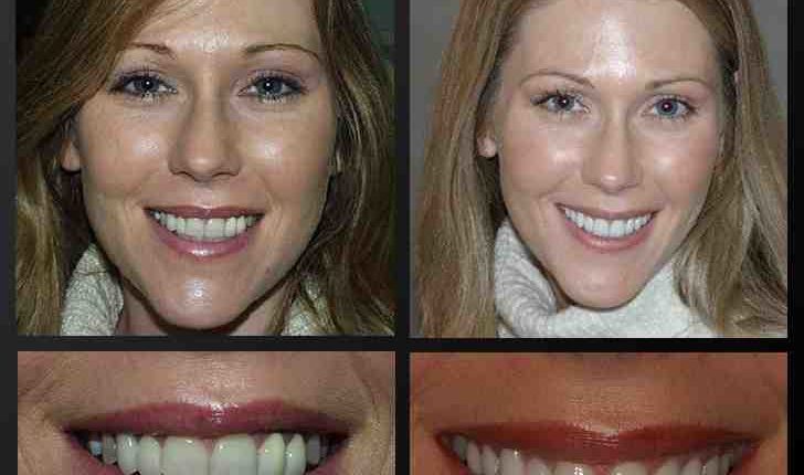 Cosmetic dentistry same day veneer