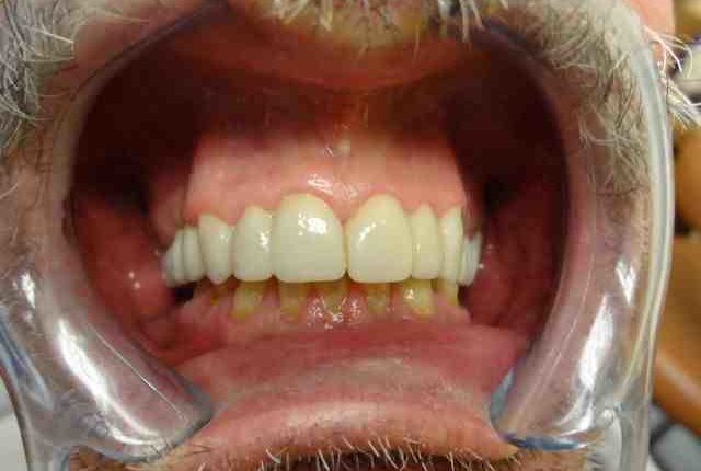 Cosmetic dentistry same.day poconos