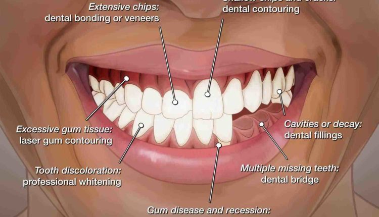 Cosmetic dentistry shaping and bonding