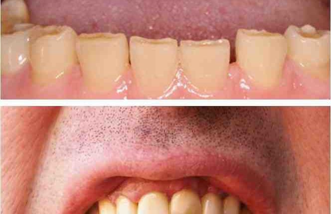 Cosmetic dentistry special effects