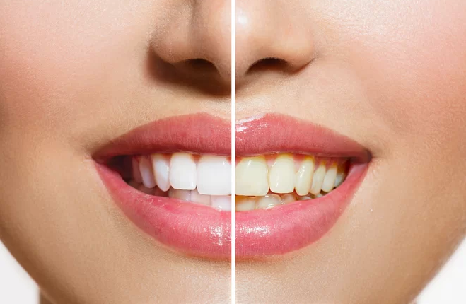 Do dental implants discolor
