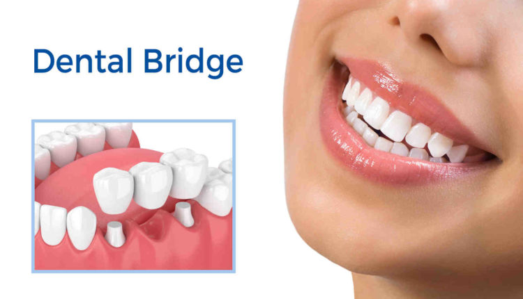 Do dental implants feel natural