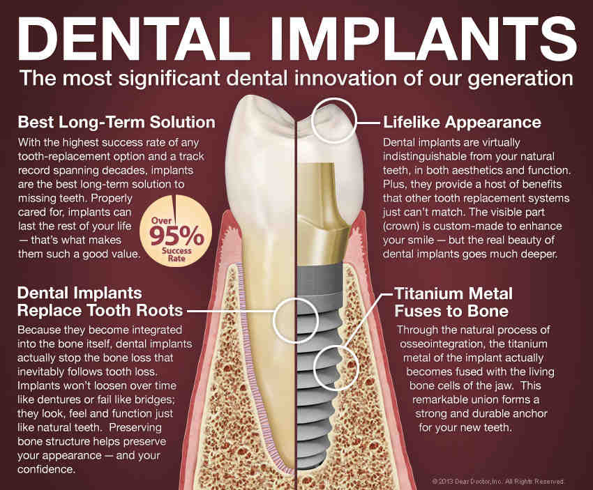 Can you feel dental implants Dental News Network