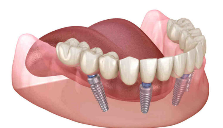 Do i really need dental implant