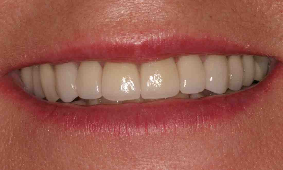 Do the Kardashians wear veneers?