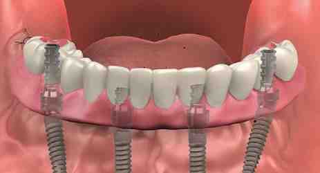Do they pull all your teeth for implants?