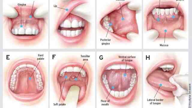 Do veneers ruin your teeth?