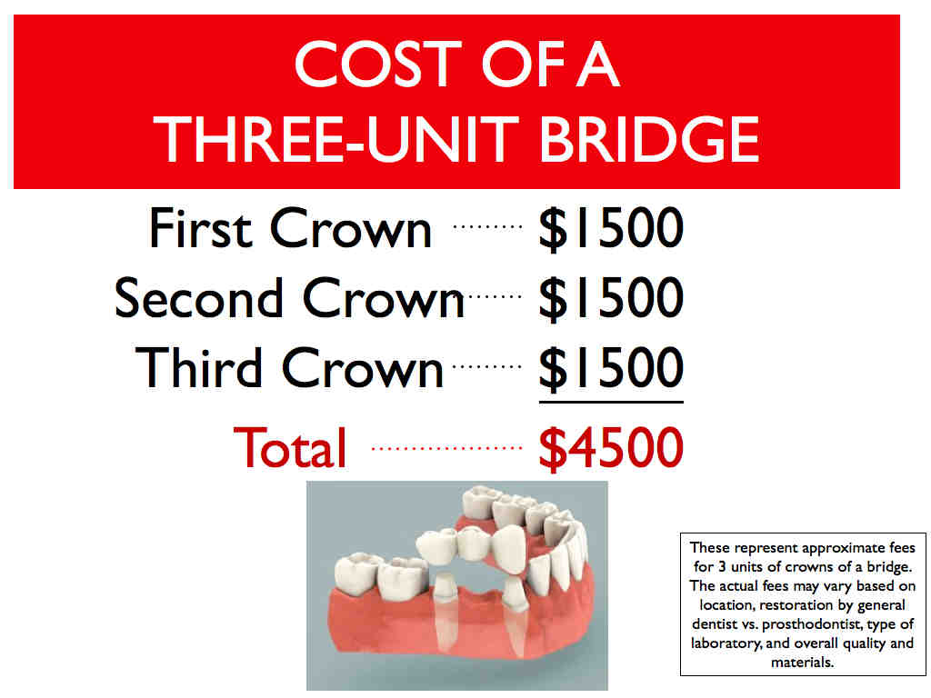 Do you need a crown after an implant?