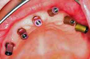 Do you need an abutment for implant?