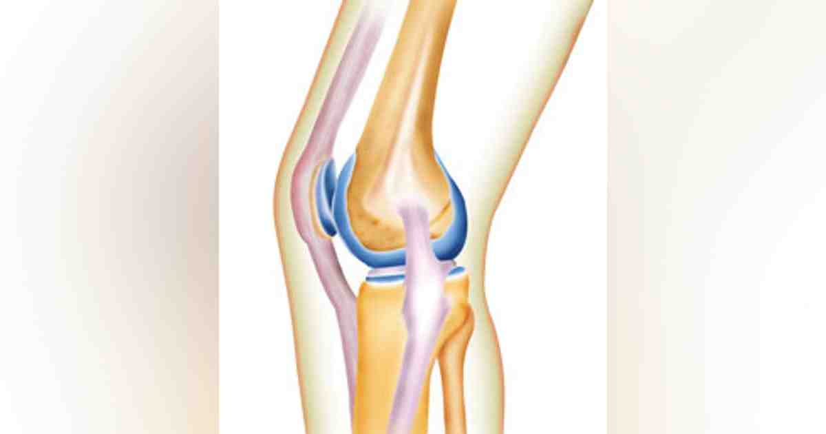 Do you need to take antibiotics before dental work after hip replacement?