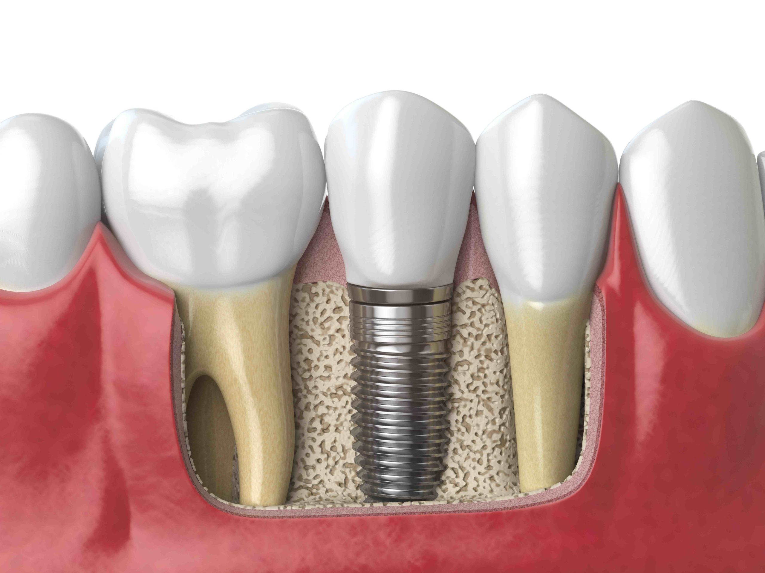 Does metlife dental ppo cover implants? Dental News Network