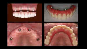 Does Walmart dental do implants?