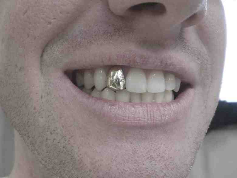 Does a crown go over an implant?