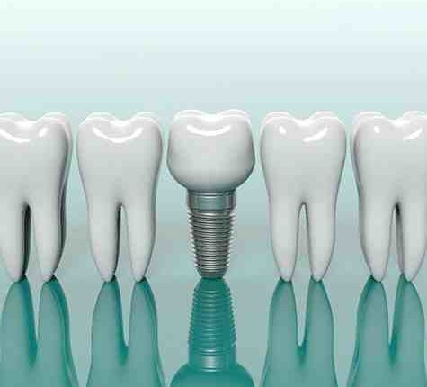 Does any dentist in dover , de put in mini dental implants
