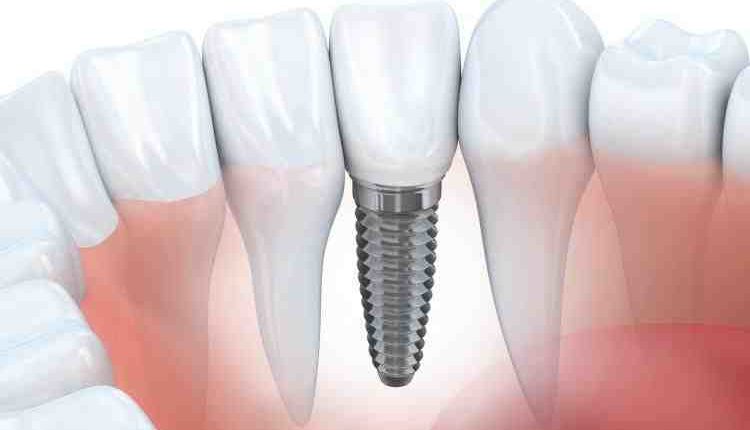 Does aspen dental do mini implants