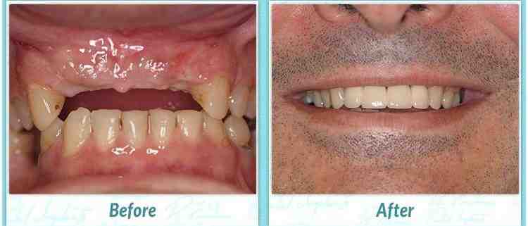 Does dental implant cost include a crown?